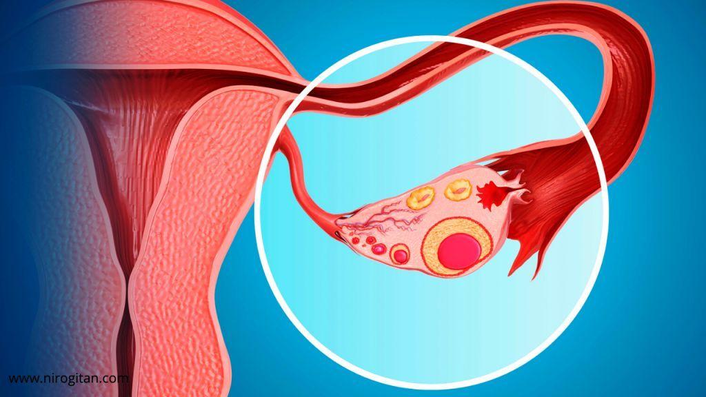Ovarian Cyst PainThe best way to reduce Nirogi Tan