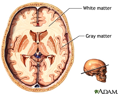White Matter Disease vs Gray Matter Disease
