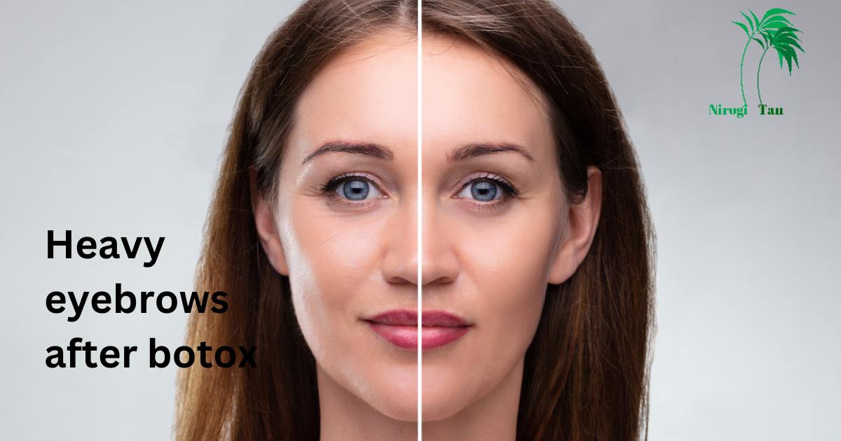 Heavy eyebrows after botox Nirogi Tan