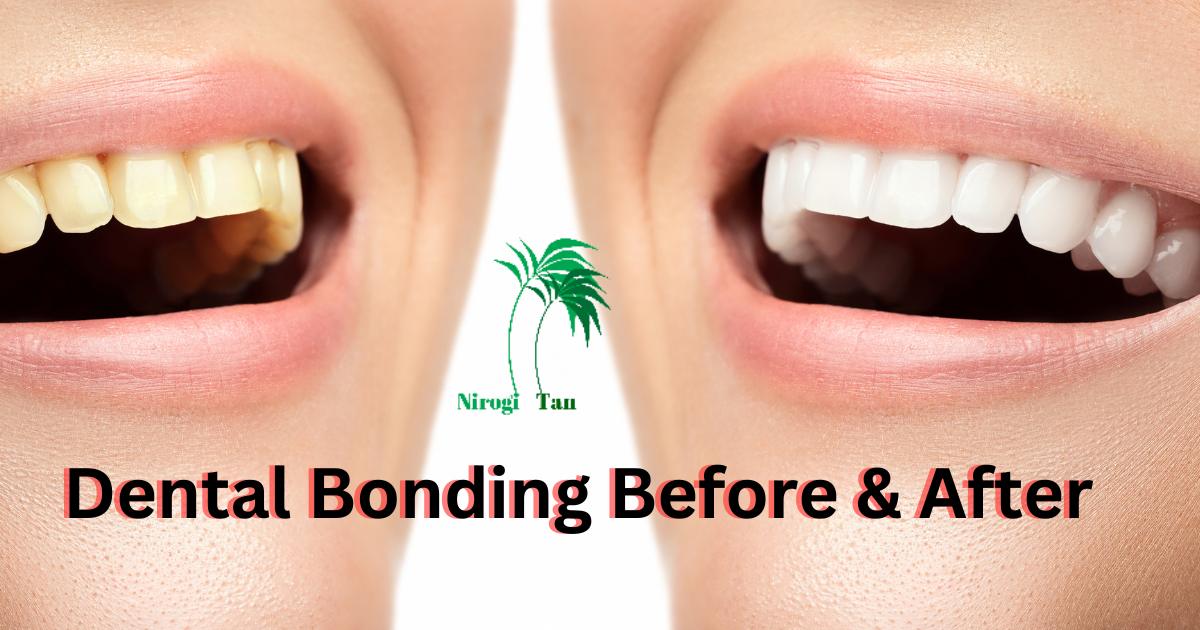 Dental Bonding Before & After Nirogi Tan