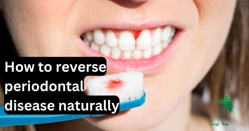 How to reverse periodontal disease naturally